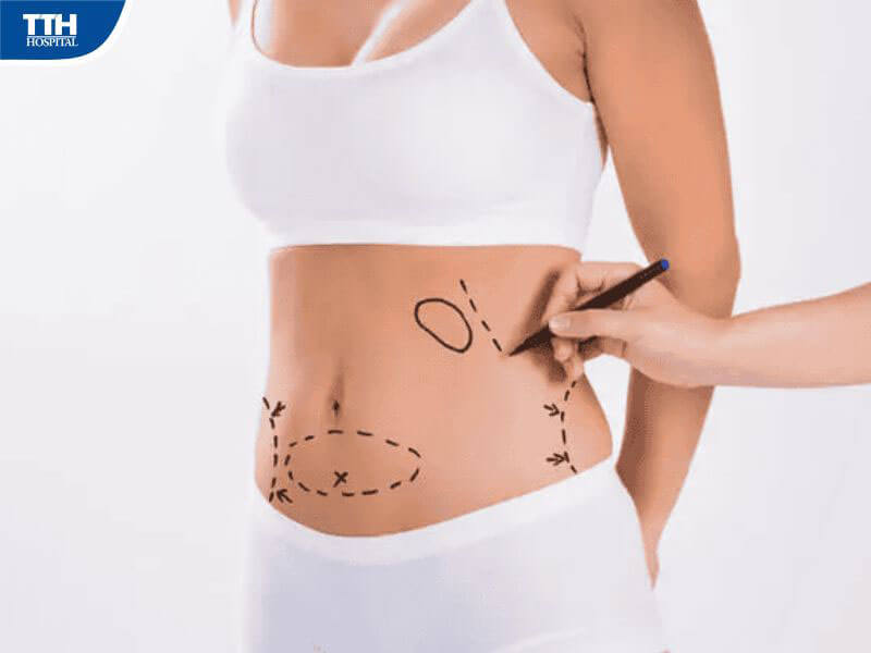 Hiểu lầm thứ 2: Hút mỡ gây đau đớn và nguy hiểm