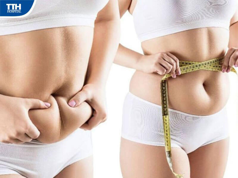 Hiểu lầm thứ 4: Chỉ người béo mới cần hút mỡ