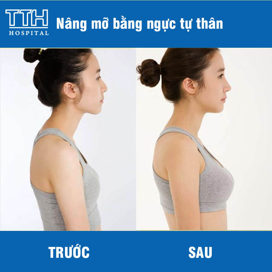 Nâng Ngực Bằng Mỡ Tự Thân