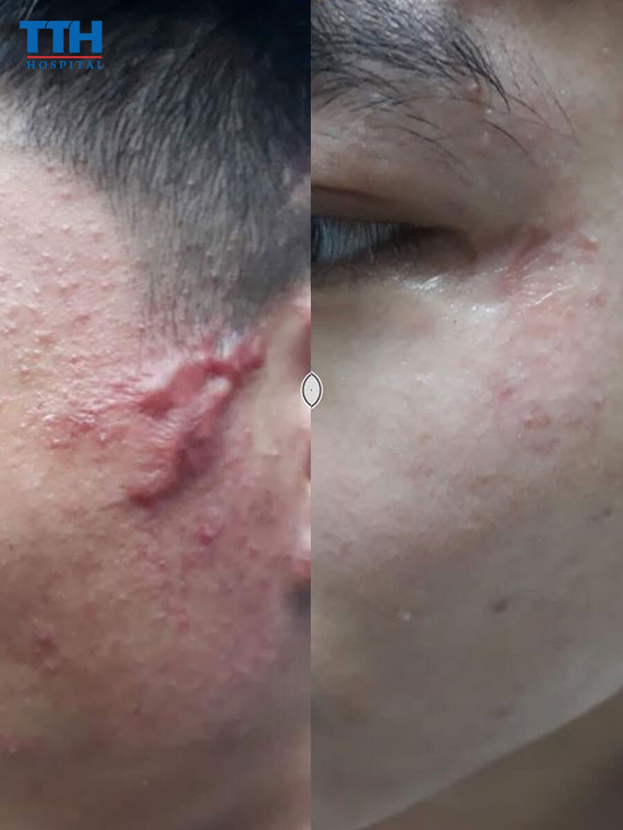 một số hình ảnh trước và sau điều trị sẹo của khách hàng