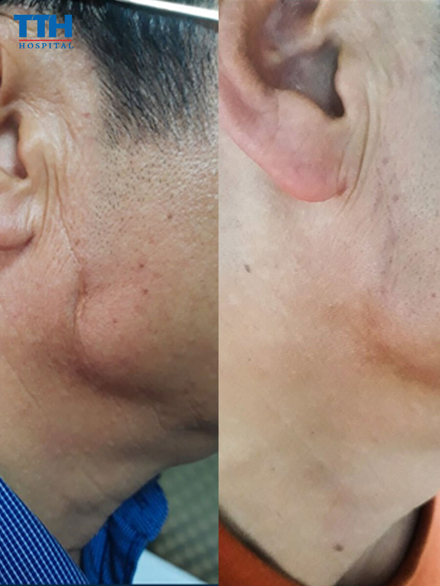 một số hình ảnh trước và sau điều trị sẹo của khách hàng