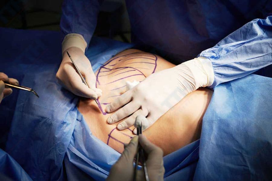 Hút mỡ - Giải pháp nhanh chóng, hiệu quả cao