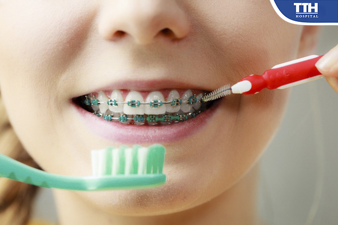 Sử dụng kết hợp các loại sản phẩm vệ sinh răng miệng dành riêng cho người niềng răng