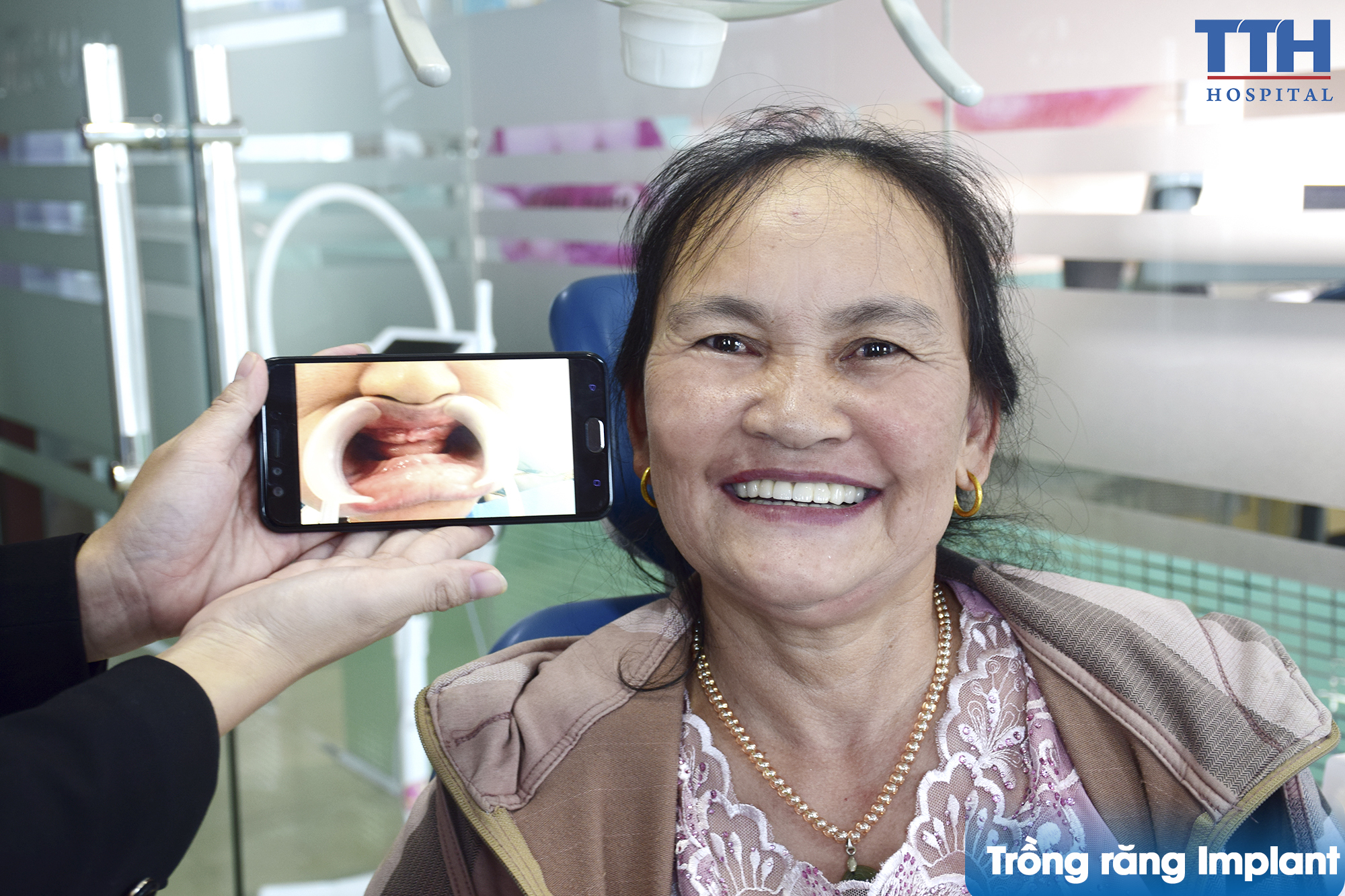 Hình ảnh khách hàng sau khi trồng răng implant toàn hàm tại bệnh viện Thái Thượng Hoàng