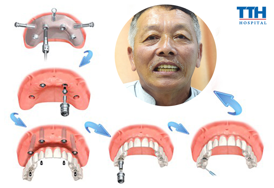 Mỗi răng bị mất đều phải cấy một trụ Implant?