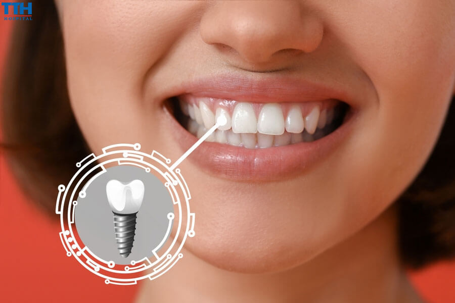 Tuổi thọ trung bình của răng implant