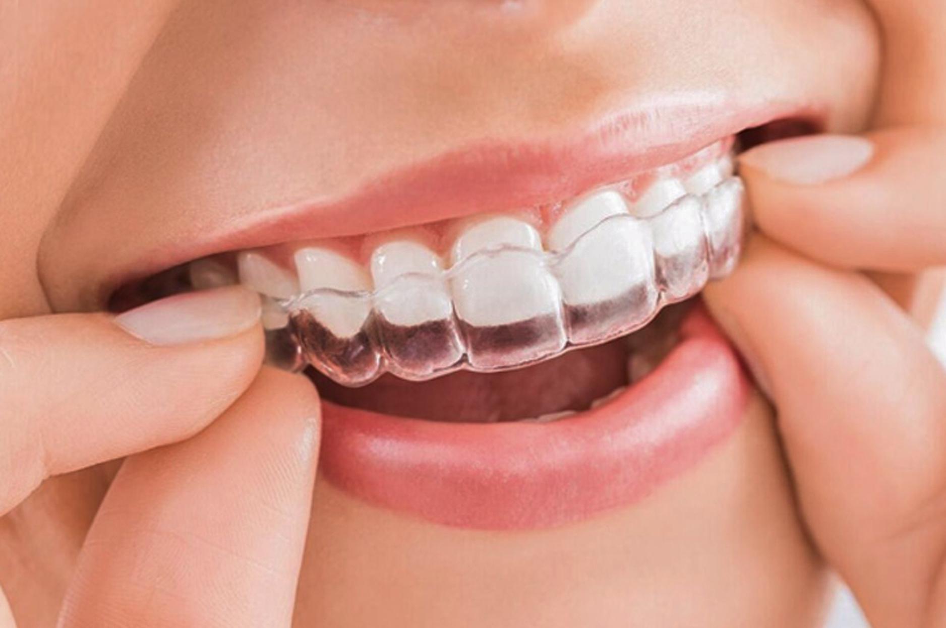 Khay niềng trong suốt dễ dàng tháo lắp là ưu điểm vượt trội hơn của Invisalign só với niềng răng mắc cài truyền thống
