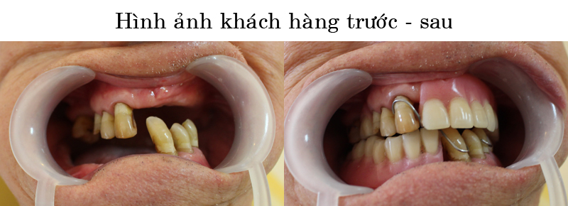 Hình ảnh hàm răng của khách hàng sau khi thực hiện lắp răng giả tại bệnh viện Thái Thượng Hoàng