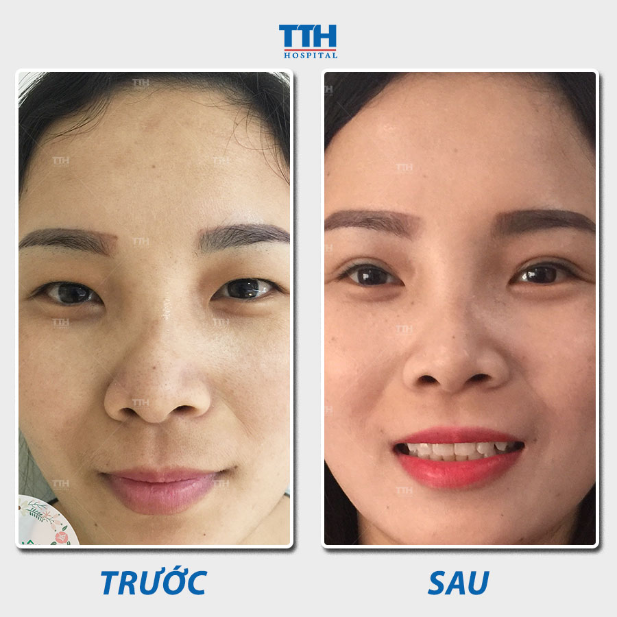 Cắt mí là quá trình tạo ra một khe mí ở mắt để tạo cảm giác mở rộng và sự lôi cuốn cho đôi mắt.