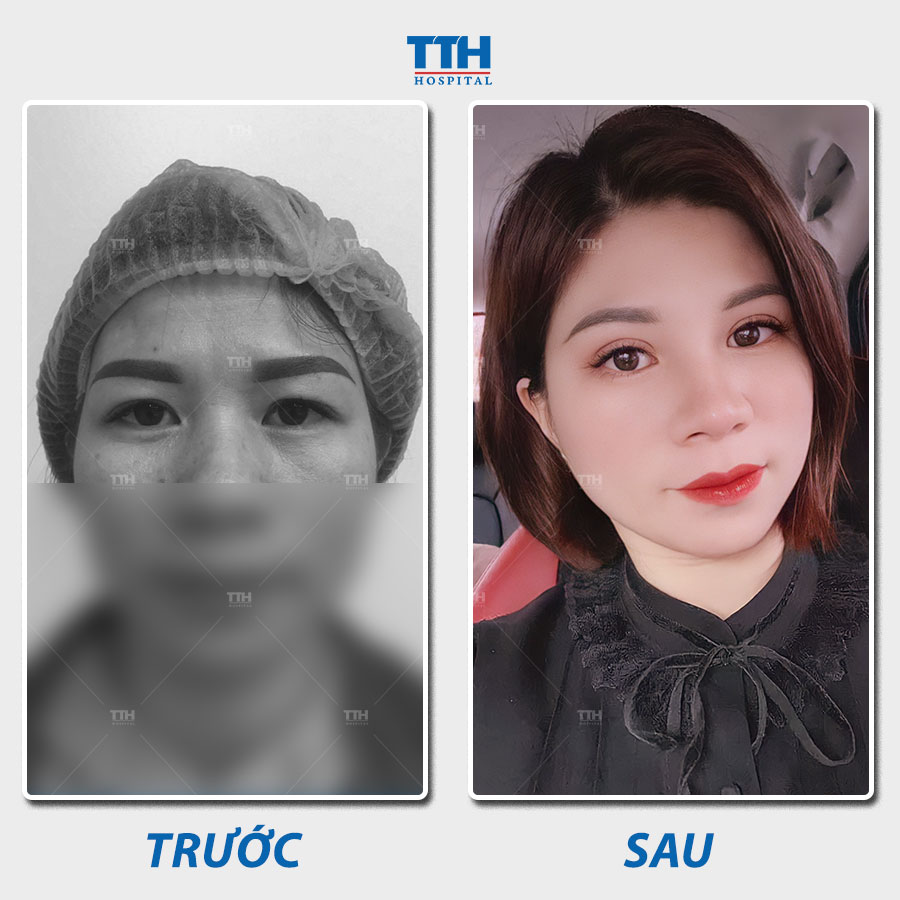 Cắt mí mắt tạo ra vẻ đẹp tự nhiên