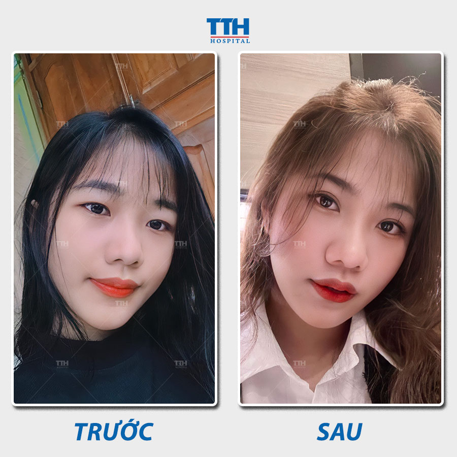 Cắt mí mắt cũng có thể giúp cải thiện các vấn đề liên quan đến vùng mi mắt.