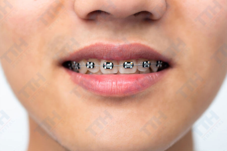 Khi nào có thể niềng răng 1 hàm?
