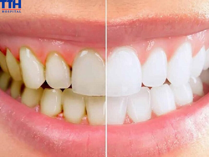 Khi nào nên đi lấy cao răng?