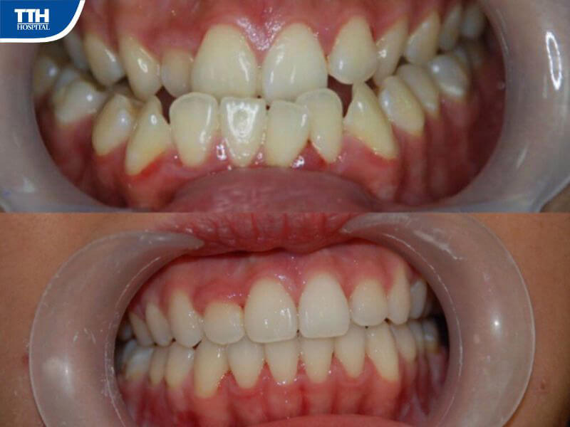 Khớp cắn ngược là gì? 