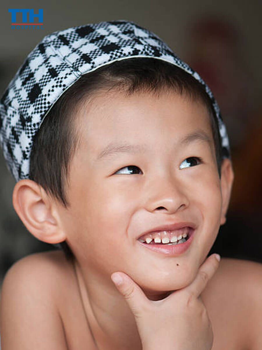 Khớp cắn ngược là gì?