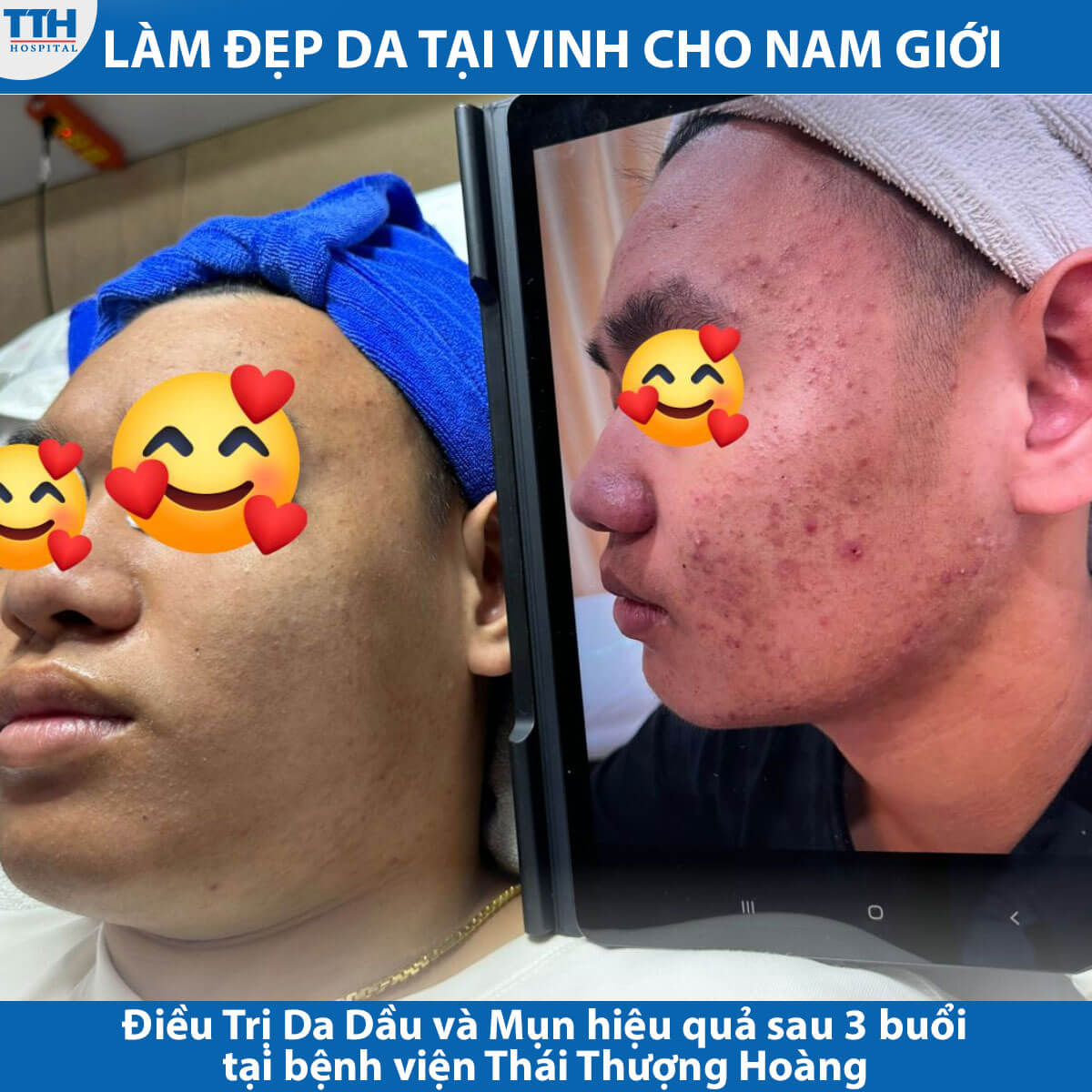 Làm Đẹp Da Tại Vinh cho nam giới - Điều Trị Da Dầu và Mụn tại Bệnh viện Thái Thượng Hoàng