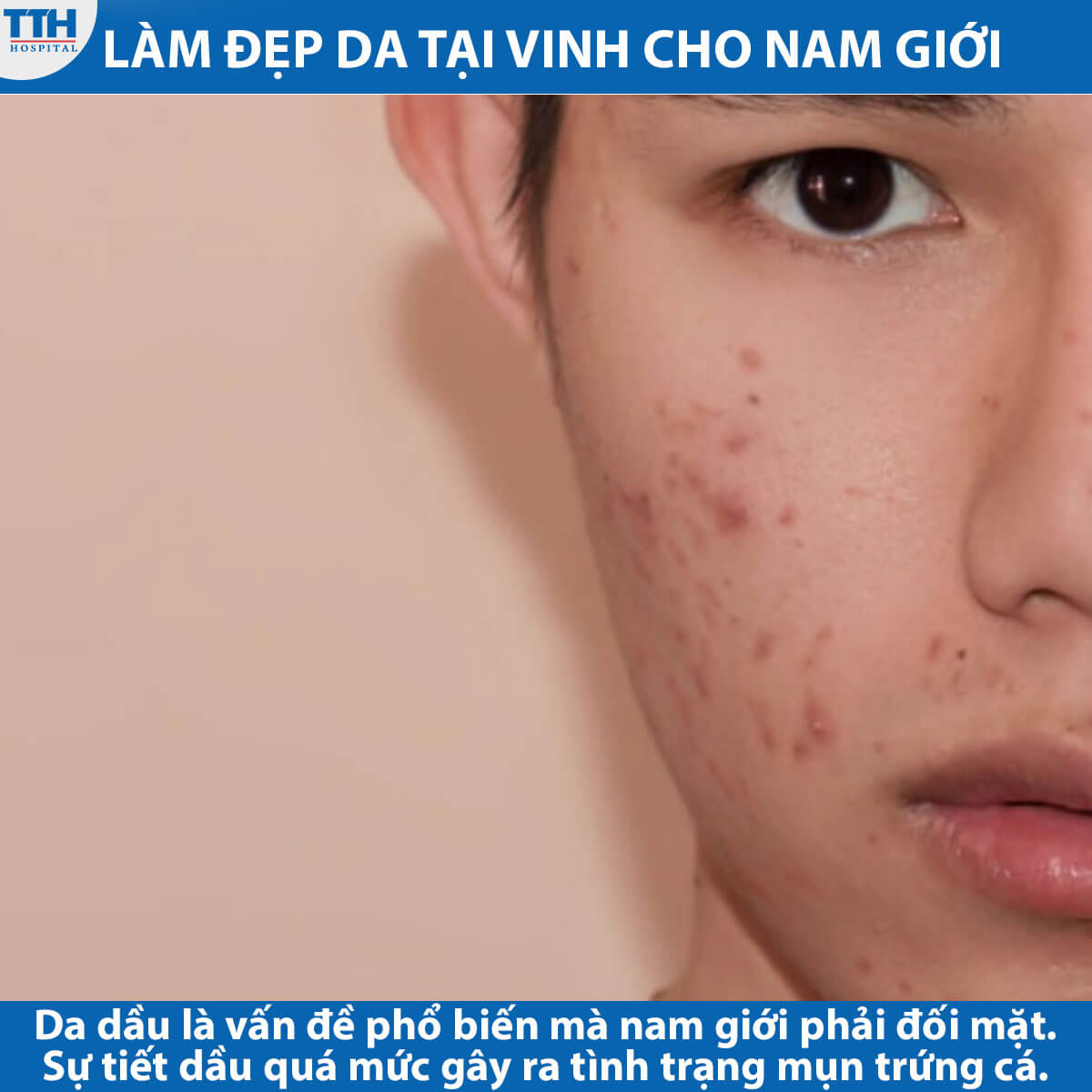 Làm Đẹp Da Tại Vinh cho nam giới - Tình Trạng Da Dầu và Mụn Trứng Cá