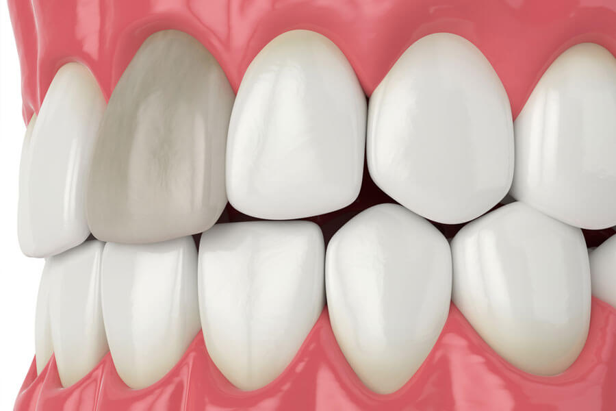 Làm thế nào để kéo dài tuổi thọ của răng chết tủy?