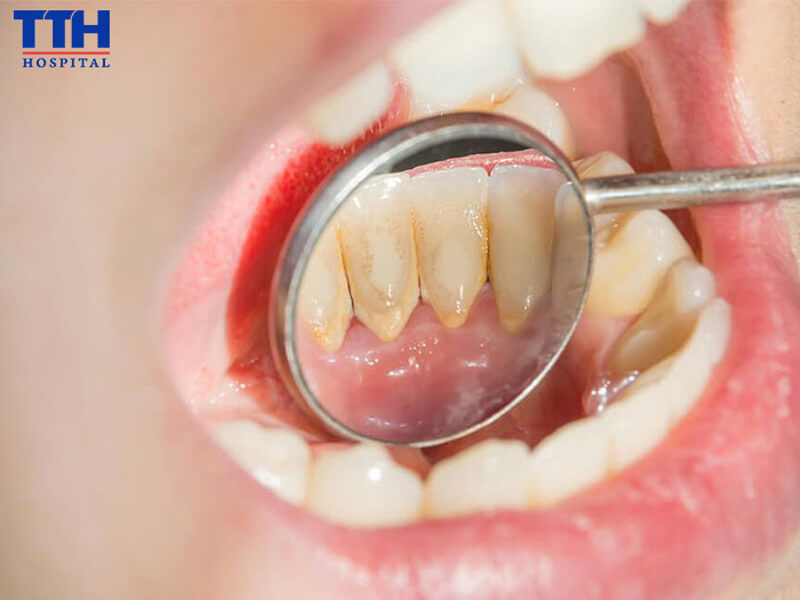 Lấy cao răng có thực sự cần thiết?