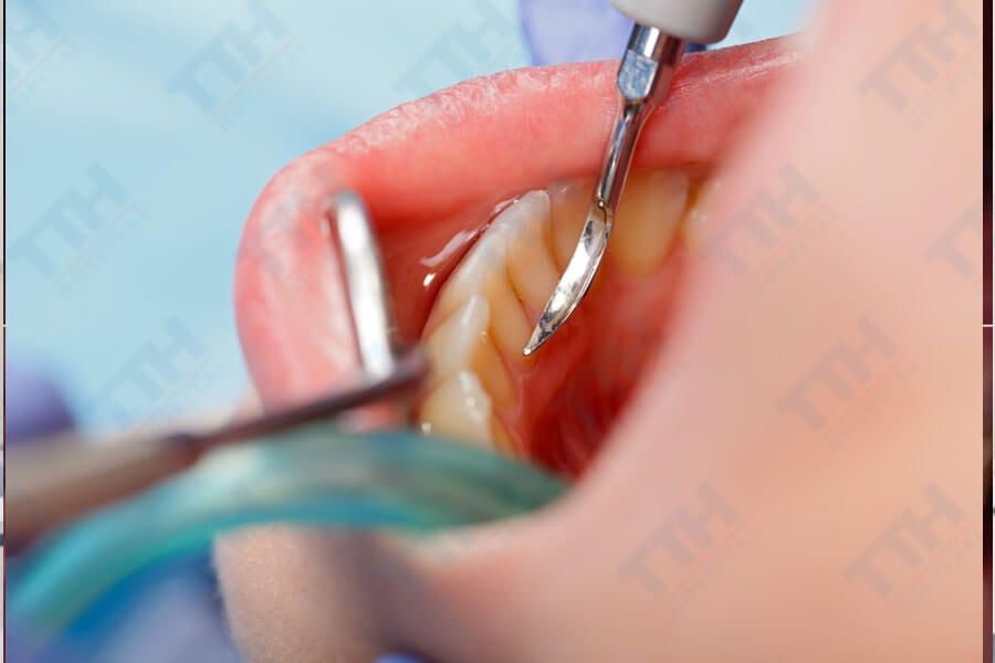 Lấy cao răng có thực sự gây mòn răng không?