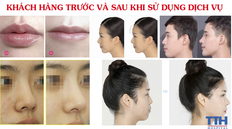 Chăm sóc sau phẫu thuật
