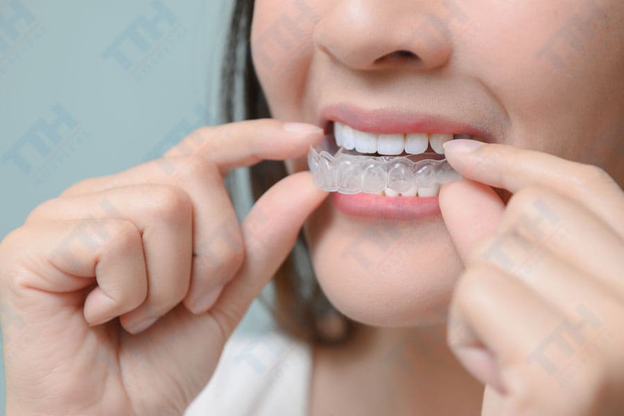Lợi ích cho khách hàng chỉnh nha