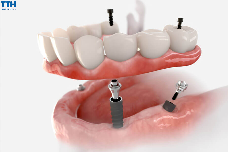 Lợi Ích Của 3D Guided Implant Surgery