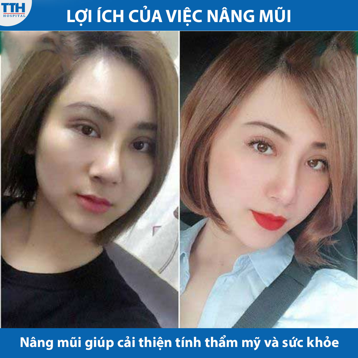 Lợi ích của nâng mũi là cải thiện tính thẩm mỹ và sức khỏe của bạn