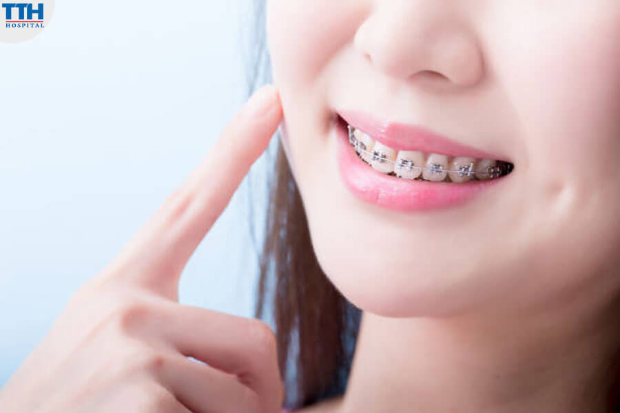 Lợi Ích Của Niềng Răng Mắc Cài Kim Loại
