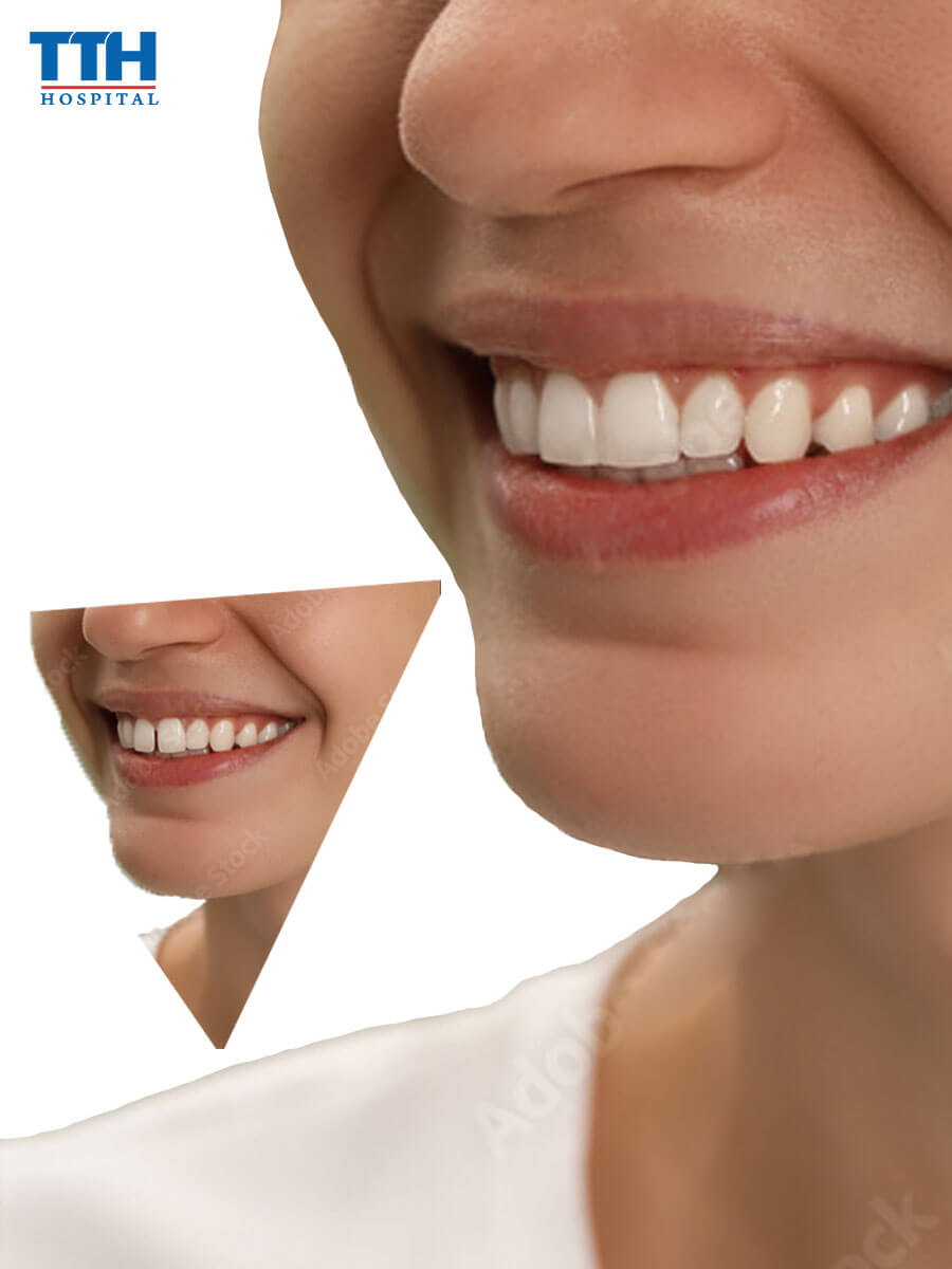 Lợi Ích Của Niềng Răng Thưa