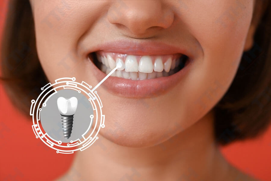 Lợi ích của việc trồng răng implant