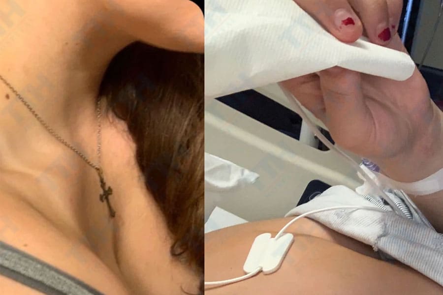 Lõm ngực từ nhỏ có thể nâng ngực được không?