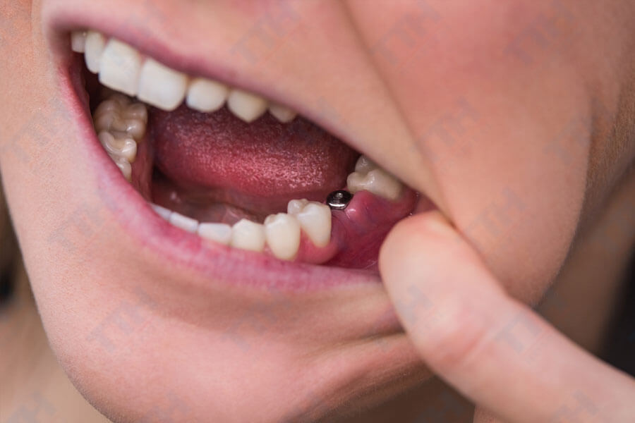 Lưu ý quan trọng khi quyết định trồng răng implant