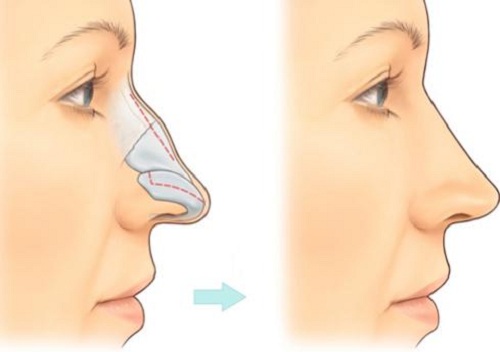 Mũi gồ là hiện tượng phần xương sống mũi không thẳng