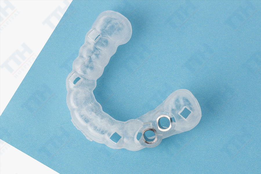 Máng hướng dẫn phẫu thuật implant là gì?