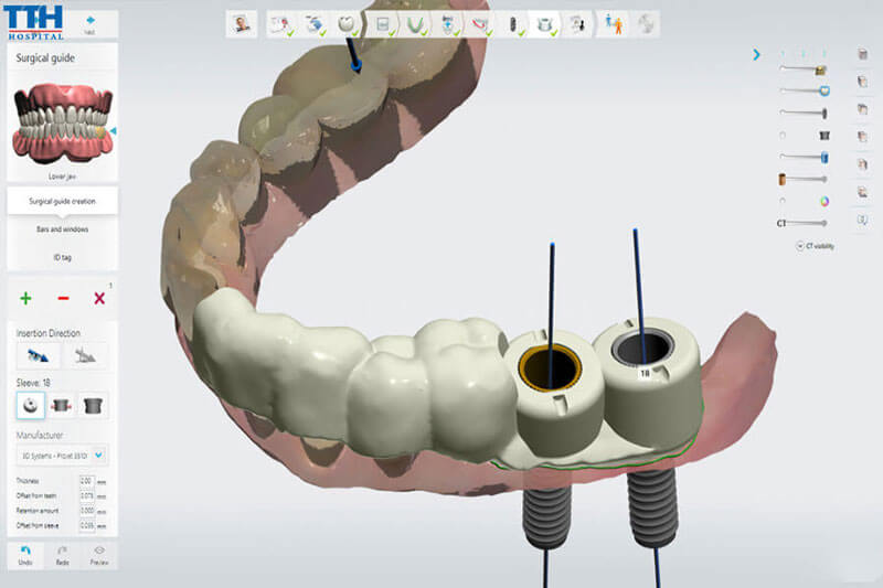 Công nghệ Máng Hướng Dẫn Phẫu Thuật 3D Guided Implant Surgery