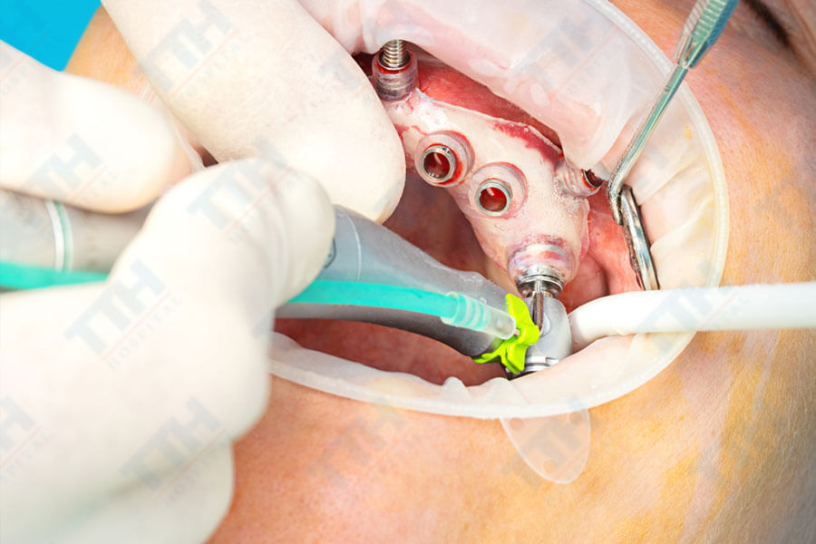 Máng hướng dẫn phẫu thuật đóng vai trò quan trọng trong việc chuẩn hóa quy trình cấy ghép implant.