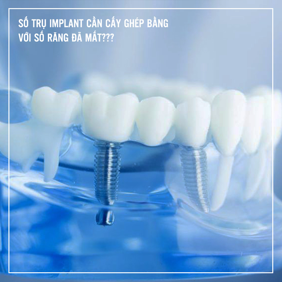 trồng răng Implant để phục hồi lại chức năng ăn nhai