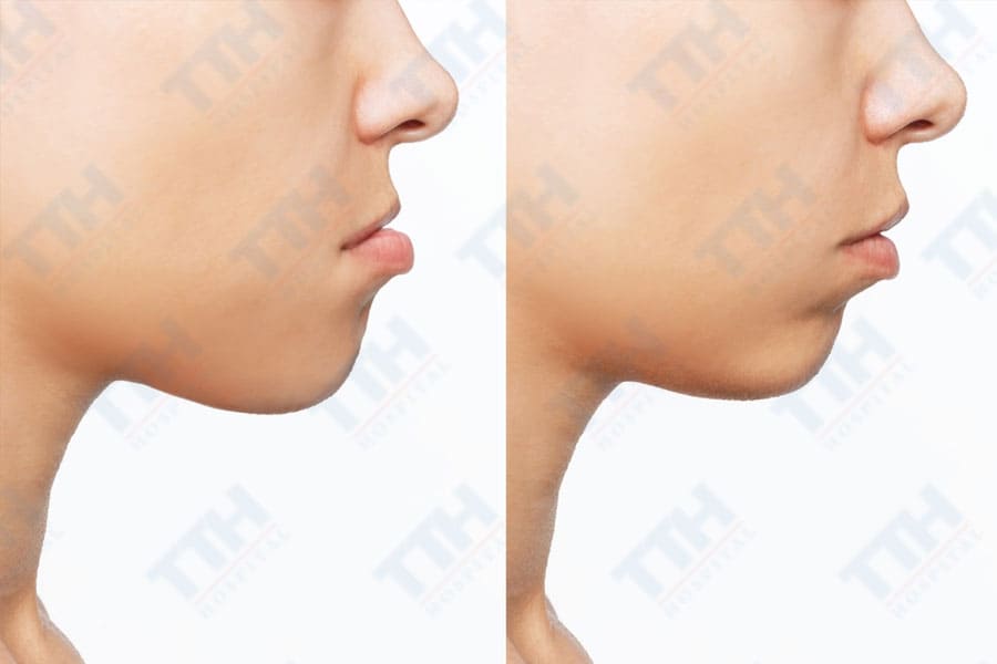 Một số câu hỏi khác về niềng răng cho người bị móm