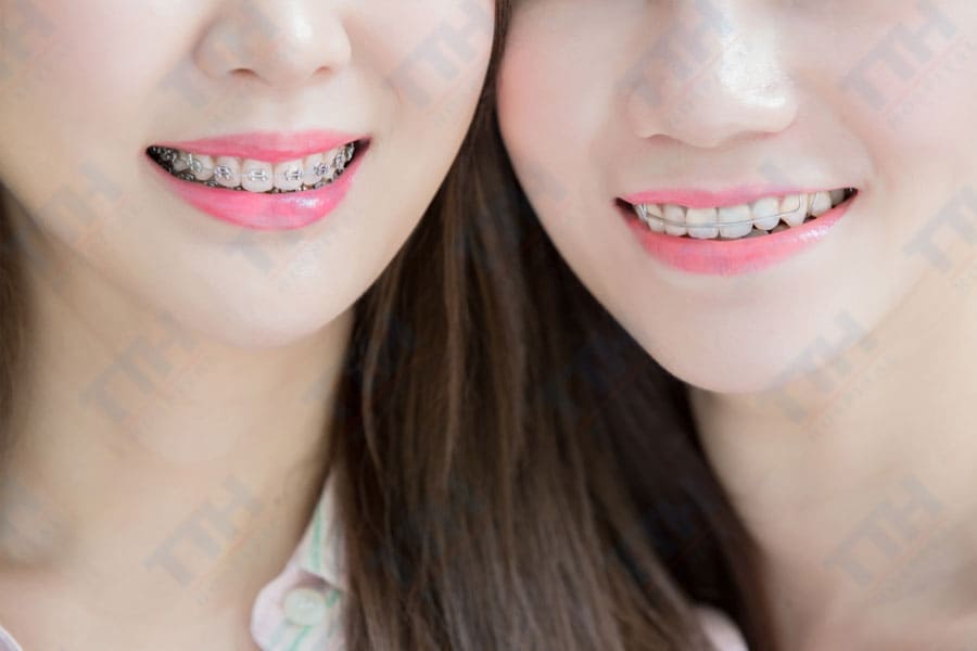 Một số câu hỏi thường gặp về niềng răng và sức khỏe răng miệng