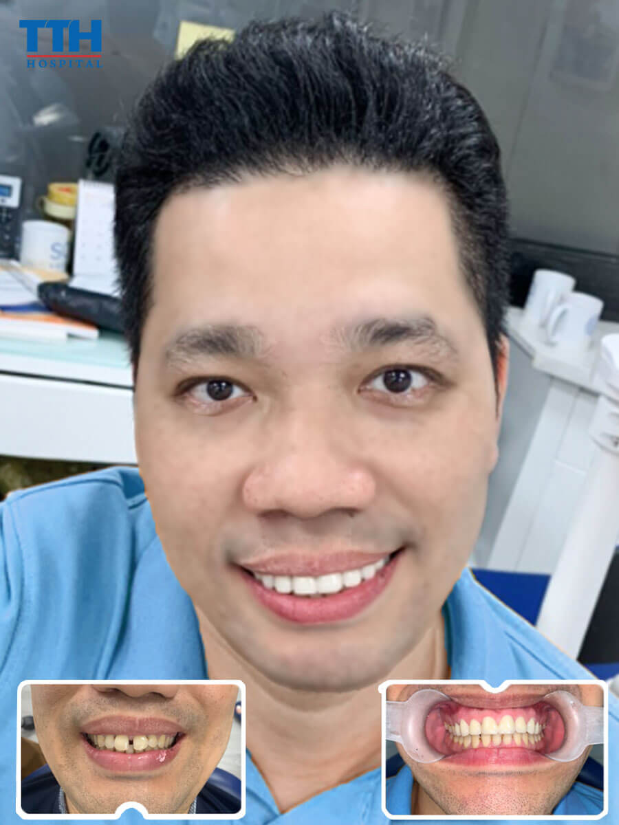 Một số hiểu lầm về đàn ông có răng thưa