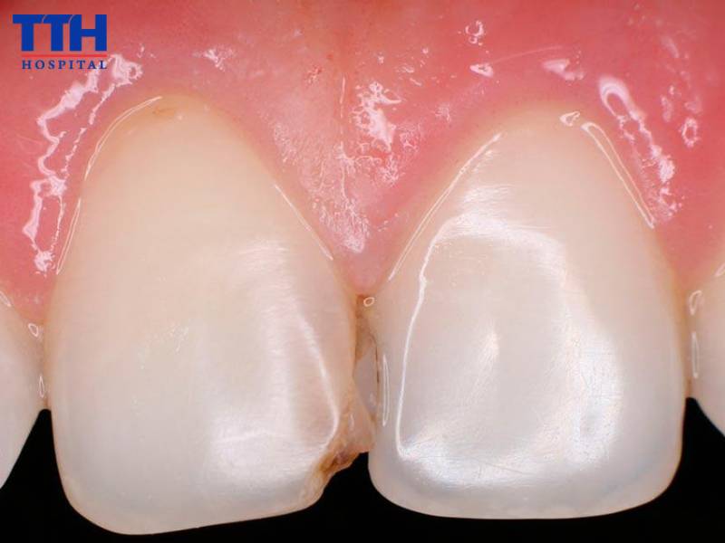 Mức độ 1 - Sâu men răng