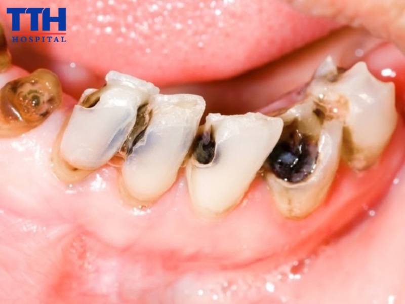 Mức độ 3 - Sâu ngà sâu, lan đến tủy