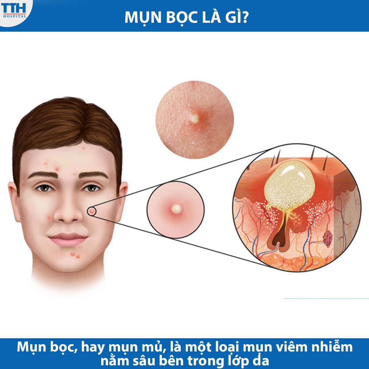 Mụn bọc là gì?