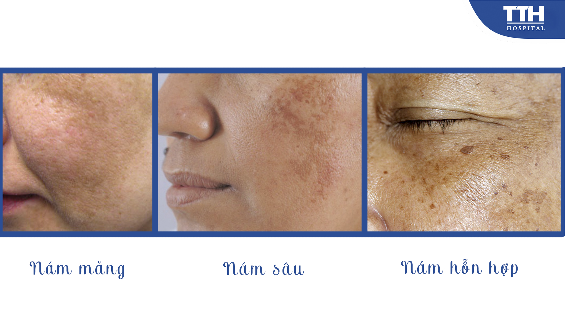 Nám chia làm 3 loại là nám mảng, nám sâu và nám hỗn hợp