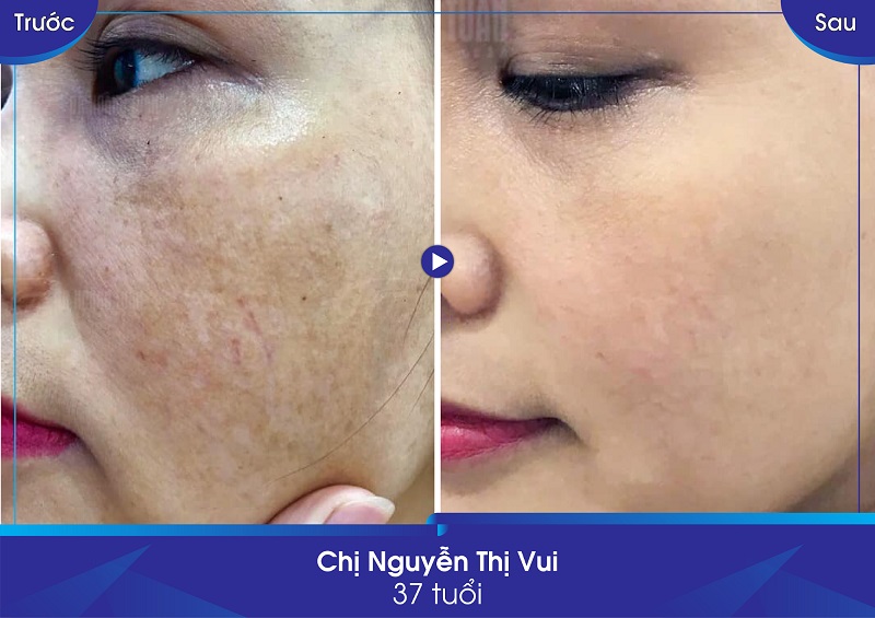 Điều trị nám, điều trị mụn. điều trị tàn nhang bằng công nghệ cao ở bệnh viện Thái Thượng Hoàng