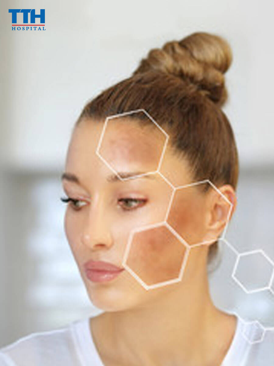 Nám da là gì? trị nám da tại vinh nghệ an