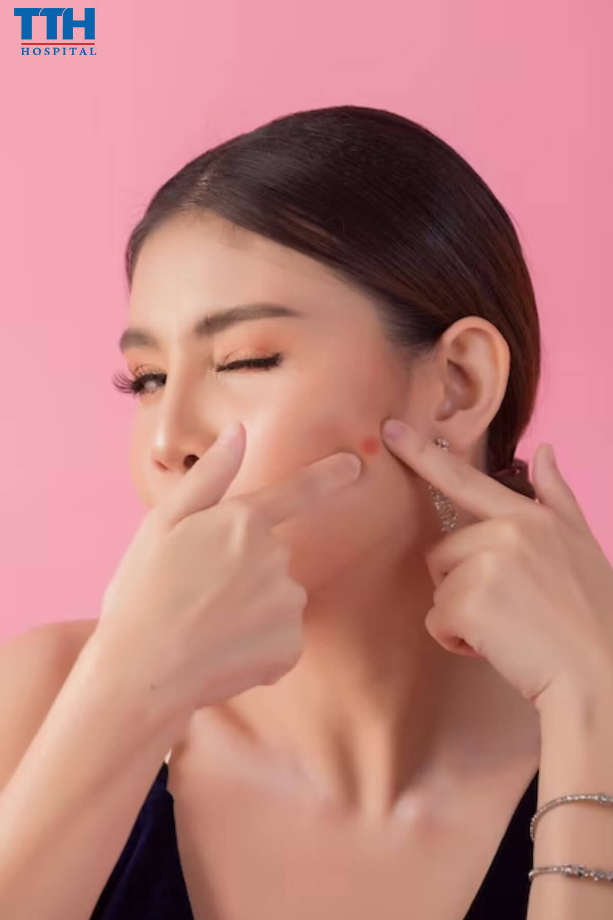 Nám da mặt vùng má trị nám tại vinh nghệ an