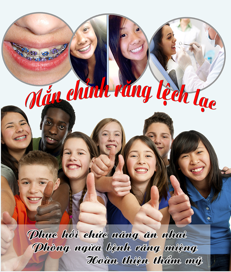 Niềng răng là gì?