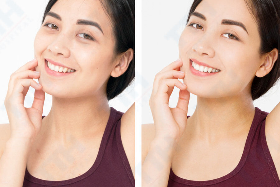 Nâng cơ Hifu - Giải pháp trẻ hóa đôi mắt hiệu quả